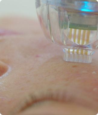 Advanced microneedling